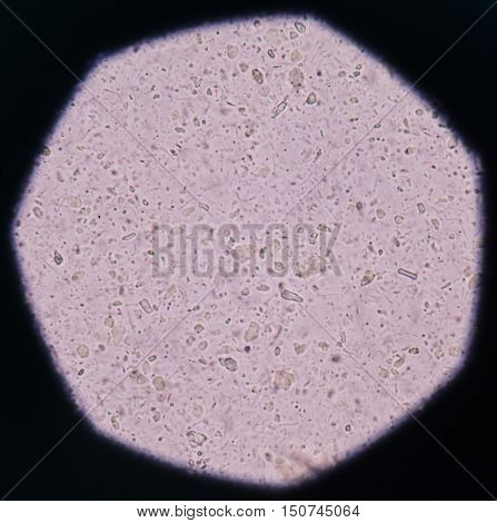 Bacteria in Urinary Tract Infections find with microscope.