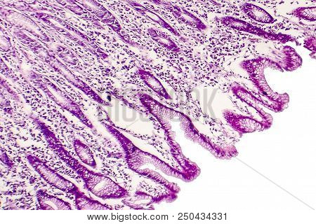 Intestinal Metaplasia Of Stomach, Light Micrograph, Photo Under Microscope