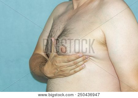 Gynecomastia, Female Breast In Men With Fat Overweight. Being Close-up Supported By The Hand