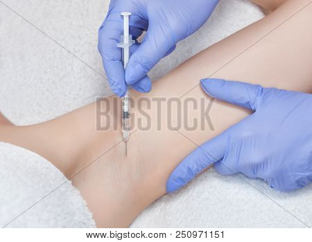 The Doctor Makes Intramuscular Injections Of Botulinum Toxin In The Underarm Area Against Hyperhidro