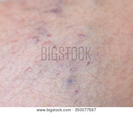 Vascular Asterisk On The Patient S Skin. The Concept Of Varicose Veins In Humans, Background, Macro,