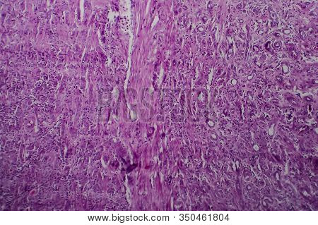Chronic Glomerulonephritis, Light Micrograph, Photo Under Microscope