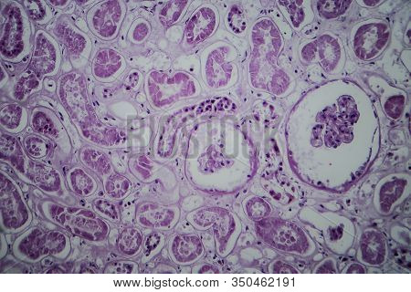 Acute Glomerulonephritis, Light Micrograph, Photo Under Microscope