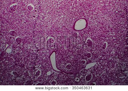 Histopathology Of Diffuse Sclerosing Glomerulonephritis, Light Micrograph, Photo Under Microscope