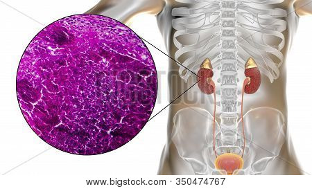 Acute Pyelonephritis, Image & Photo (Free Trial) | Bigstock