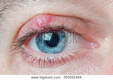 Chalazion On The Eyelid Of A Man Close-up