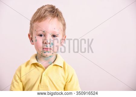 Young Toddler,boy With Chickenpox. Sick Child With Chickenpox. Varicella Virus Or Chickenpox Bubble