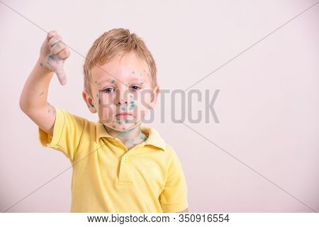 Young Toddler,boy With Chickenpox. Sick Child With Chickenpox. Varicella Virus Or Chickenpox Bubble