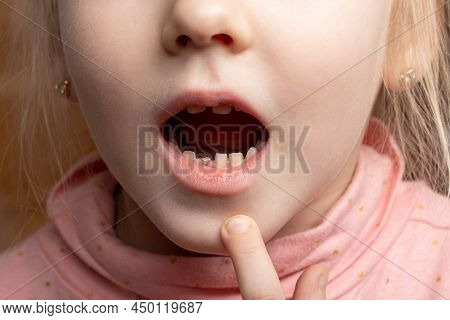 A Child With An Open Mouth Without One Milk Tooth In The Jaw. Change Of Milk Teeth. Bleeding Gums