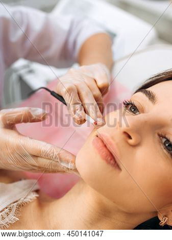 Closeup Image Of Dermatologists Hands Doing Electro-epilation. The Process Of Electrolysis On The Fa