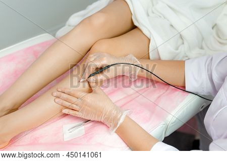 Dermatologist Doing Hair Removal Treatment On Patients Leg With Electrolysis. Depilation And Beauty 