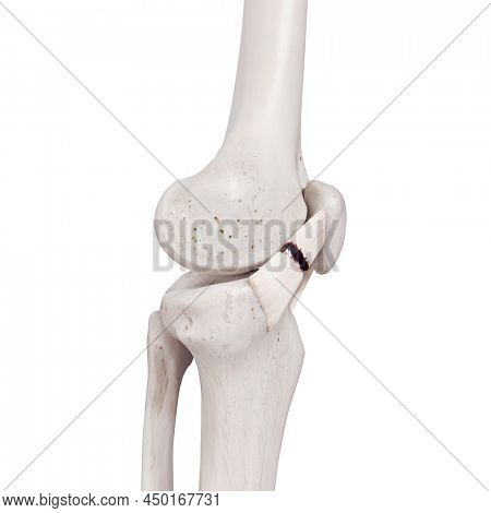 3d rendered medically accurate illustration of a torn medial patellar ligament
