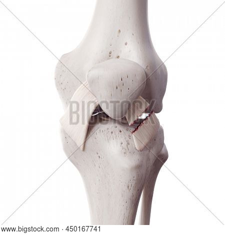 3d rendered medically accurate illustration of a torn lateral patellar ligament