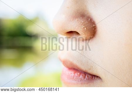 Allergic Young Woman Have Eczema Dry Nose On Winter Season,female People Peeling Skin With Seborrhei