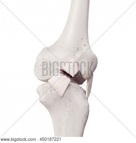 3d rendered medically accurate illustration of a torn medial patellar ligament