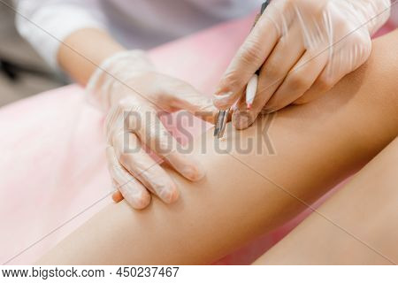 Dermatologist Doing Hair Removal Treatment On Patients Leg With Electrolysis. Depilation And Beauty 