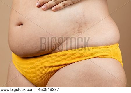 Cropped Photo Of Fat Overweight Pregnant Woman Hand On Belly, Navel In Yellow Pants, With Stretch Ma