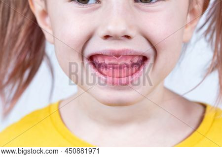 Six-year Old Caucasian Girl Shows Myofunctional Trainer. Dental Tariner Is Made To Help Equalize The