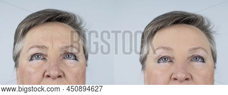 Forehead Wrinkle. Photos Before And After Mesotherapy, Biorevitalization, Botulinum Toxin Injections
