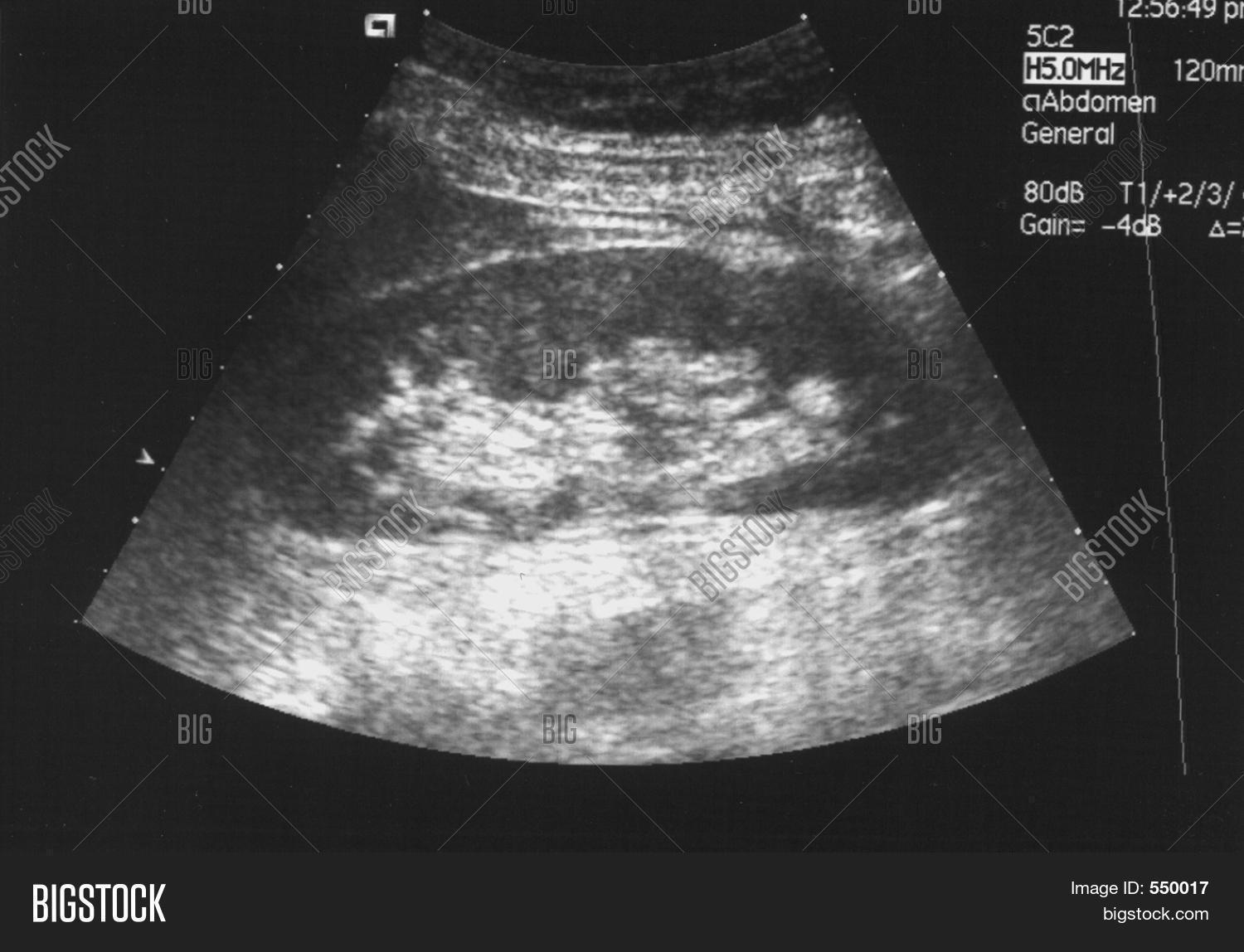 Kidney anatomy ultrasound