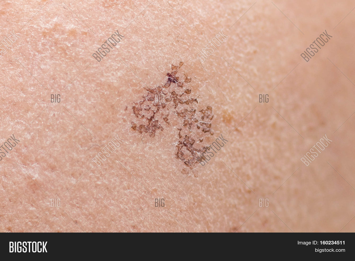 Wound Scar On Female Image & Photo (Free Trial) Bigstock