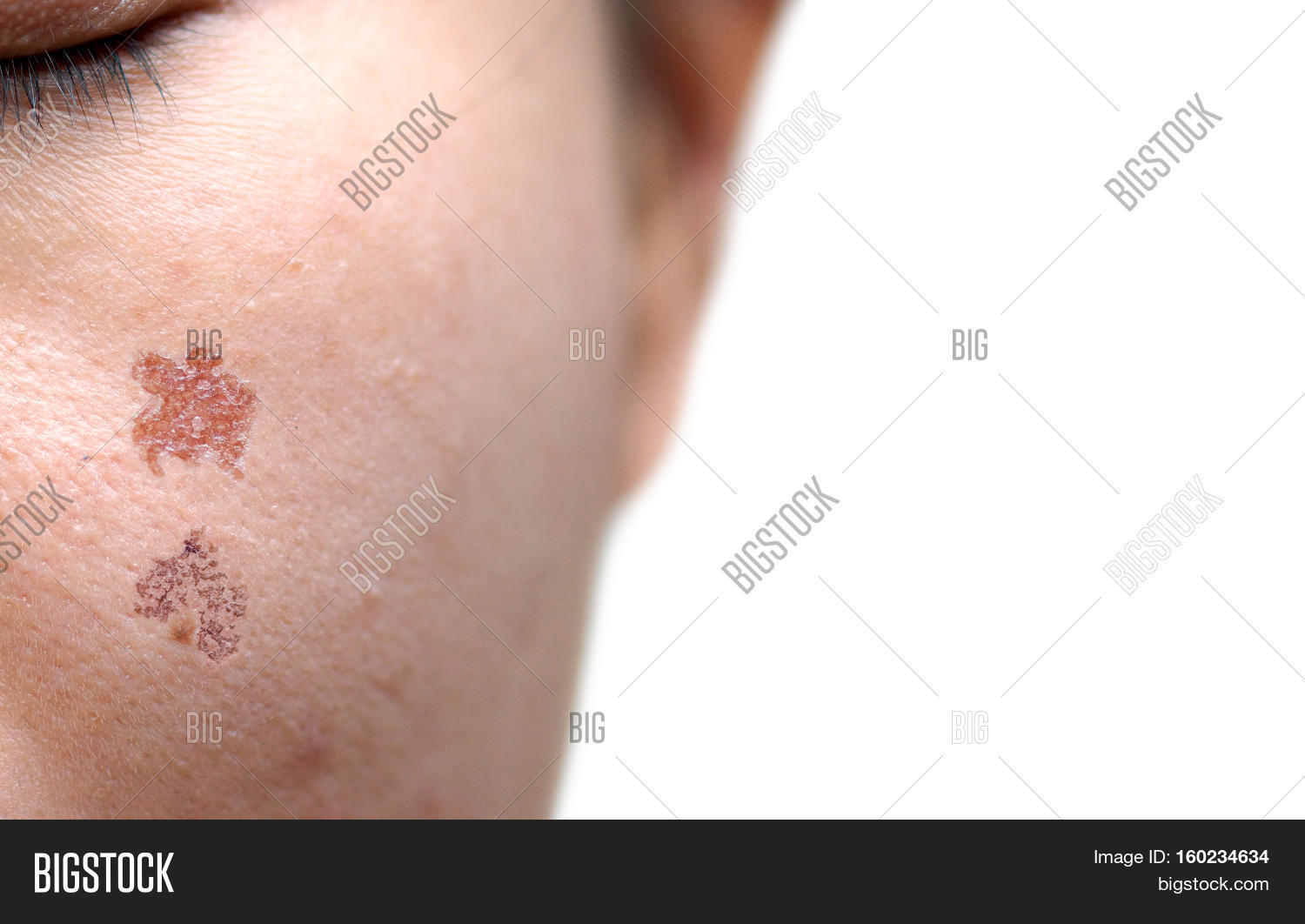 Wound Scar On Female Image & Photo (Free Trial) Bigstock