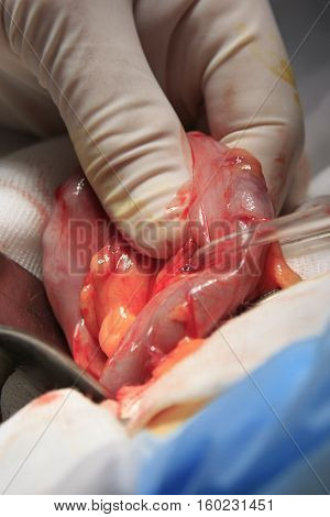 Intestine macro pulled out and holded by surgeon's fingers during the colostomy surgery