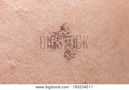 Wound scar on female face resulting from laser treatment / Beauty and skin treatment concept