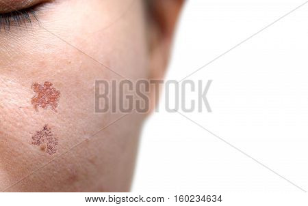 Wound scar on female face resulting from laser treatment / Beauty and skin treatment concept