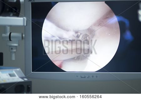 Arthroscopy Surgery Screen