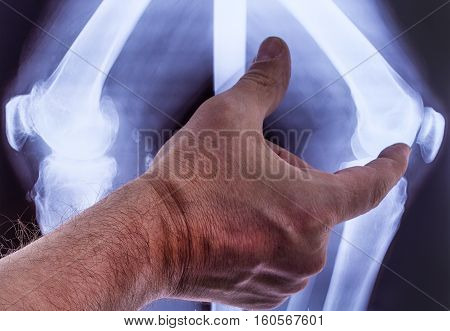 Doctor studying x-rays of the hand of the two knees