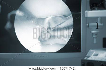 Arthroscopy Surgery Screen