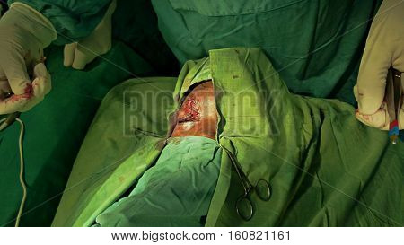 Z plasty eyelid surgery. Z- shaped incision. Surgery field. Different steps for this surgery