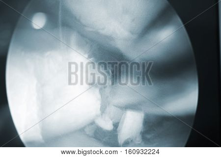 Arthroscopy Surgery Screen
