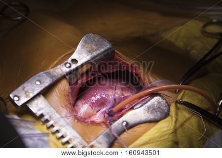 Three-year child heart with connected tubes of heart-assist device during the surgery