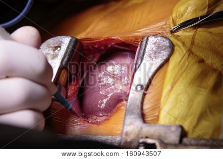 Open child's heart surgery with opened thorax and beating heart close-up