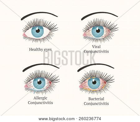 Conjunctivitis, Pink Eyes. Eye Disease. Ophthalmology Flat Health Illustration. Most Common Conjunct