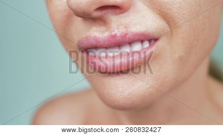 Herpes On The Female Lips. Close-up, Blue Background, Blur