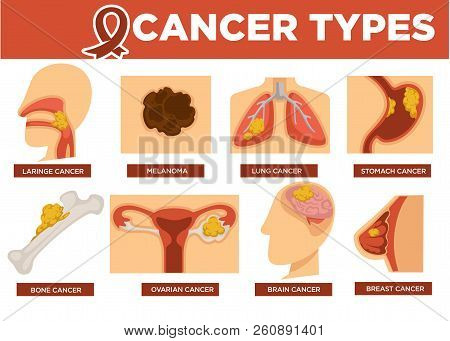 Cancer Types Poster With Kinds Of Disease Vector