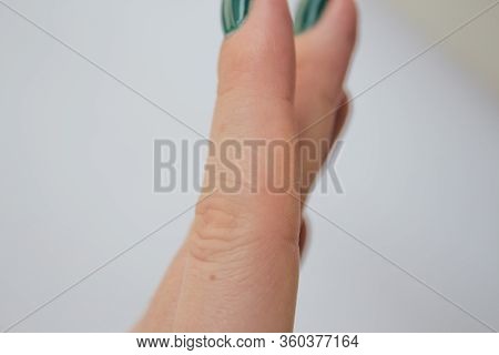 Scar On Finger Man On Image & Photo (Free Trial) | Bigstock