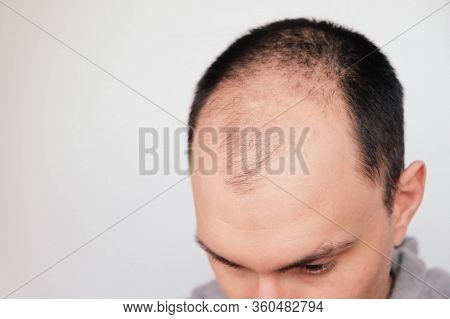 Young Man Losing Hair On Temples, Close Up.