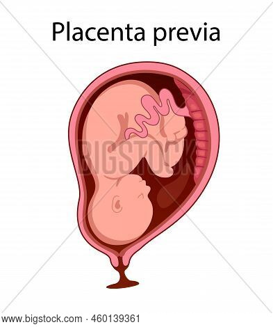 Placental Previa. Fetus In Uterus During Pregnancy. Women Anatomy. Fetus With Umbilical Cord And Pla