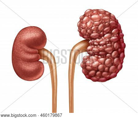 Chronic Kidney Disease Or Ckd As Human Kidneys Concept As One Healthy And Polycystic Disease With Cy