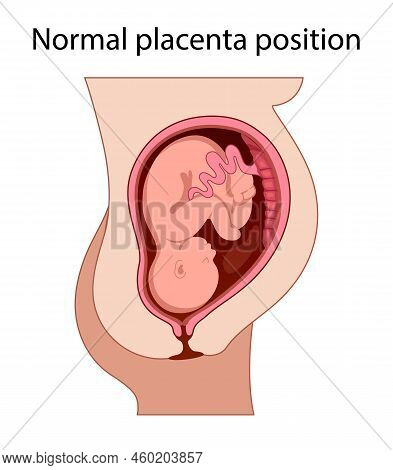 Different Placental Locations.  Fetus In Uterus During Pregnancy. Normal, Top, Low Previa And Front 