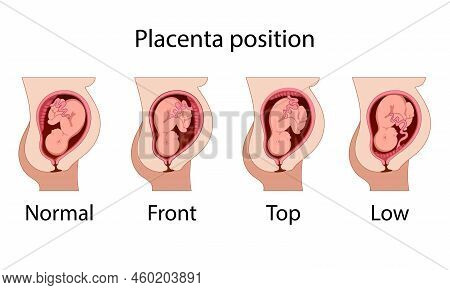 Different Placental Locations.  Fetus In Uterus During Pregnancy. Normal, Top, Low Previa And Front 