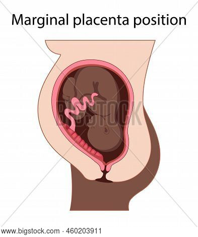 Different Placental Locations.  Fetus In Uterus During Pregnancy. Normal, Top, Low Previa And Front 