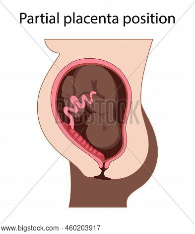 Different Placental Locations.  Fetus In Uterus During Pregnancy. Normal, Top, Low Previa And Front 