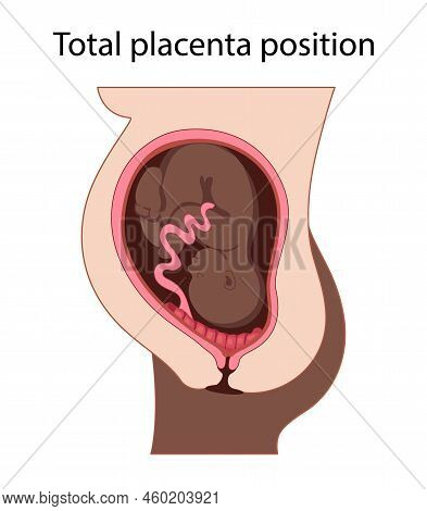 Different Placental Locations.  Fetus In Uterus During Pregnancy. Normal, Top, Low Previa And Front 