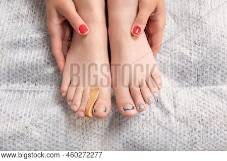 Close-up Of The Hands Holding Female Feet With A Bracket On The Nail And A Silicone Impression Inser