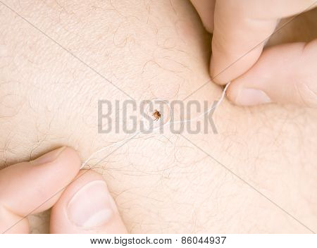 Removing A Tick With Thread From Skin